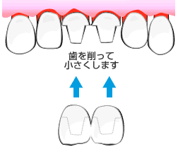 ホワイトニングでは芸能人のような白い歯は手に入らない 君想う 故に我在り